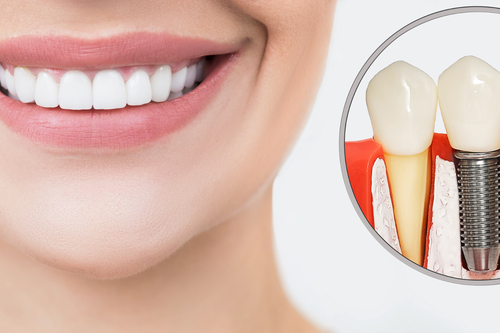 Восстановление всех зубов по методу All-on-6