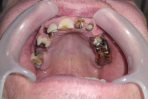 Терапевтическое лечение, удаление зубов, коронки + проф. гигиена