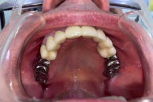 Терапевтическое лечение, удаление зубов, коронки + проф. гигиена