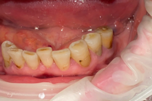 Удаление зуба, частичные съемные протезы