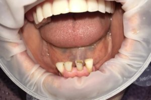 Удаление зубов, полный съемный протез