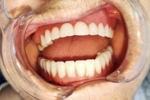 Удаление зубов, полный съемный протез