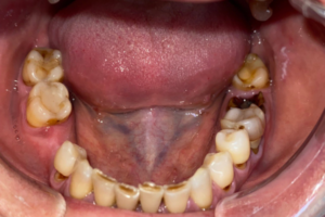 Удаление зубов, терапевтическое лечение, восстановление под металлокерамическую коронку, съемных протезы
