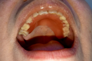 Удаление зубов, терапевтическое лечение, восстановление под металлокерамическую коронку, съемных протезы