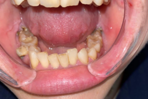 Удаление зубов, терапевтическое лечение, восстановление под безметаллическую коронку