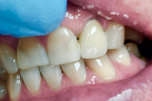Восстановление 22 зуба