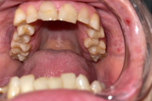 Удаление зубов, терапевтическое лечение, восстановление под безметаллическую коронку